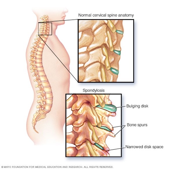 آرتروز گردن چیست و چگونه درمان می‌شود؟