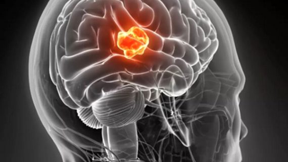تومور مغزی چگونه جراحی می شود ؟
